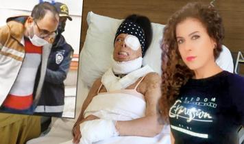Eski sevgilisi vücuduna kezzap atmıştı! Yaşadığı acı tecrübeyi anlattı böyle anlattı
