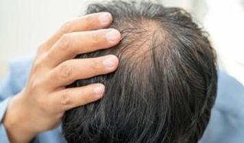 Kalıtsal kelliğin tedavisinde devrim! Bilim insanları başarı sağladı