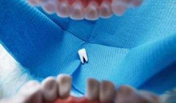 Bir saatiniz var! Düşen dişi kaybetmeden yapmanız gerekenler