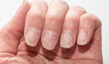Tırnaklardaki çizgiler ne anlatıyor?