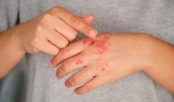 Egzama hastalarına kritik uyarı! Stres seviyeleri doğrudan etkiliyor