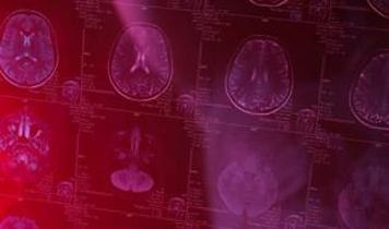 Basit bir vitamin, agresif beyin kanserine karşı savaşta fark yaratıyor