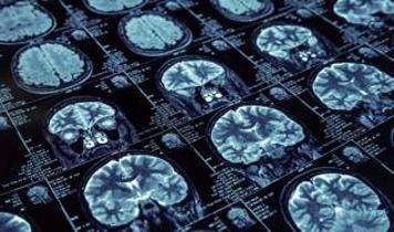 Alzheimer'ın gizemi çözülüyor mu? Yeni teori dikkat çekti