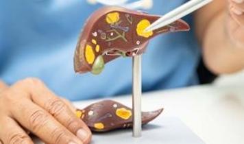 14 bin kişi incelendi! Karaciğer yağlanmasında dikkat çeken veri