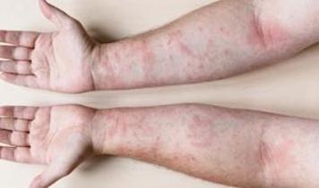 Uyku kalitesi sedef hastalığı riskini etkiliyor mu? 405 bin kişiden dikkat çeken veriler