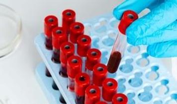 Metabolik sorunların izleri kan testlerinde görülebilir! İşte dikkat edilen değerler