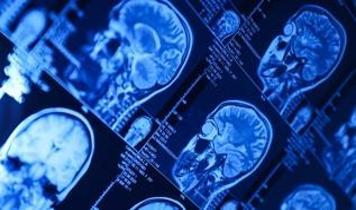 Alzheimer aslında "Tip 3 Diyabet" mi? Bilim dünyasını ikiye bölen "Beyin Diyabeti" hipotezi