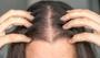 Kadınlarda saç dökülmesinin temel nedenleri nelerdir?